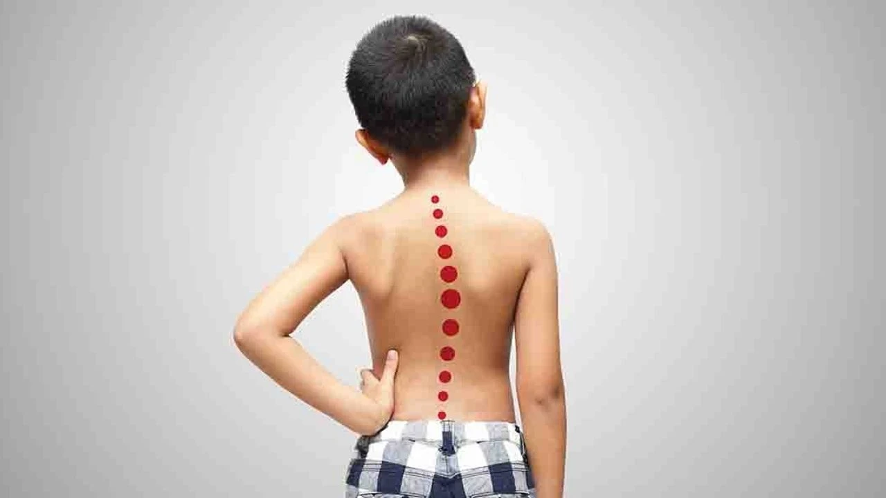 Spor Yaparak Skolyoz ile Mücadele: Sağlıklı Sırtlar İçin Temel Çözüm!